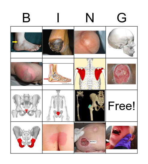Pressure Injuries Bingo Card